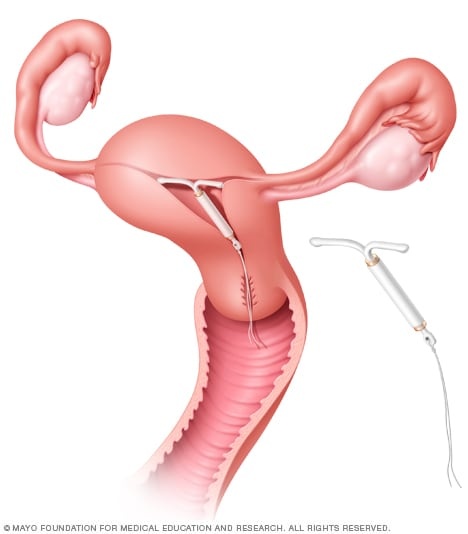mirena-sistema-a-rilascio-intrauterino-20-microgrammi-24-ore
