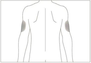 Diagram of the human back with shaded areas indicating possible injection sites on the arms
