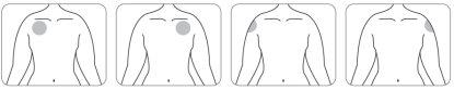 Scheme of human torso showing four injection areas on the arm, with a shaded area indicating the application site