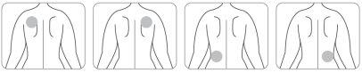 Four silhouettes of the human back showing injection points on the upper arm, varying in lateral position