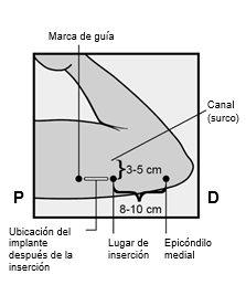 Diagram of the arm showing medial epicondyle, groove, insertion site, and implant location with measurements of 3-5 cm and 8-10 cm