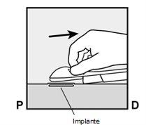 Hand holding rectangular implant over skin with arrow indicating position and label