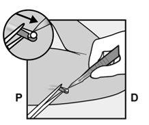 Needle being inserted into the skin at an angle, detailed view showing the needle tip and skin, arrows indicating direction P and D
