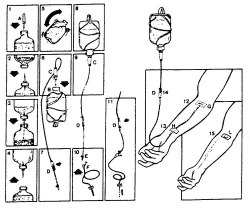 Preparazione e connessione di una sacca per infusione venosa ad un braccio con ago inserito e regolatore di flusso