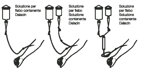Soluzioni per flebo contenenti Dalacin collegate a un supporto, con tubicini e gocciolatori illustrati