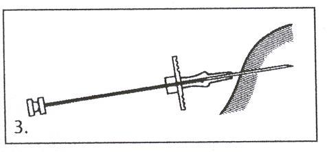 Siringa con ago che penetra nella pelle ad angolo retto con indicazione della posizione del pistone e del cappuccio protettivo