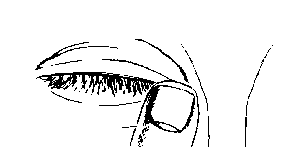 Occhio che riceve una goccia di liquido medicinale applicata da un contagocce bianco e nero