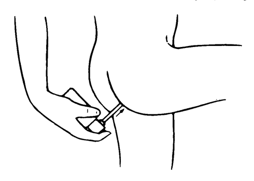 Iniezione sottocutanea nel gluteo con ago inserito e posizione della mano che stabilizza l
