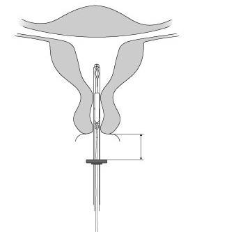 Catetere venoso centrale inserito in vena cava superiore con misurazione della distanza