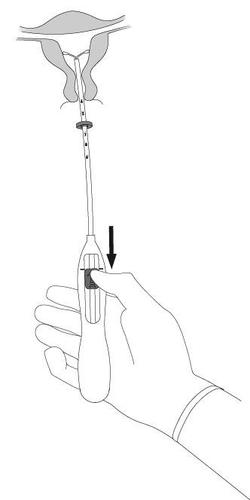 Mano che tiene un applicatore intravaginale con stantuffo e freccia nera indicante la direzione di inserimento