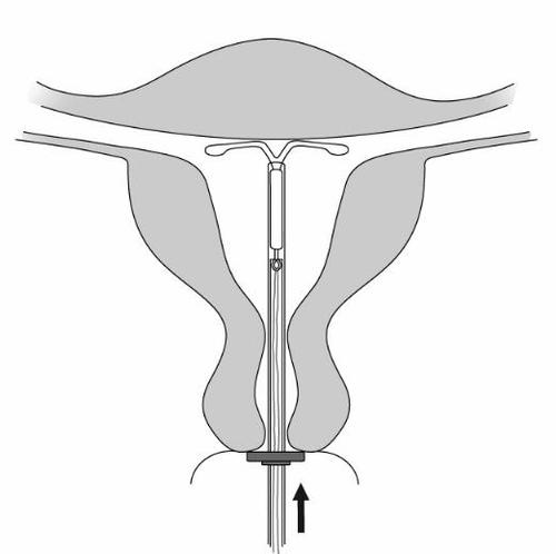 Dispositivo intrauterino a forma di T posizionato all