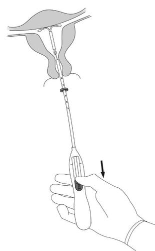 Dispositivo intrauterino a forma di T inserito nell