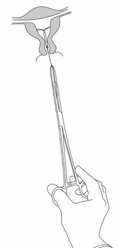 Pinza chirurgica che afferra un tessuto all