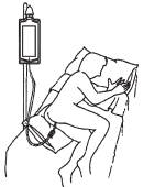 Paziente sdraiato di lato con braccio flesso e connesso a un dispositivo medico tramite tubicini e un supporto verticale