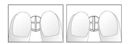 Due viste schematizzate delle ginocchia con un impianto protesico a croce centrale posizionato tra i condili femorali