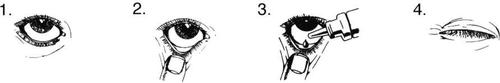 Occhio umano visto frontalmente in quattro fasi di applicazione di gocce liquide con un contagocce