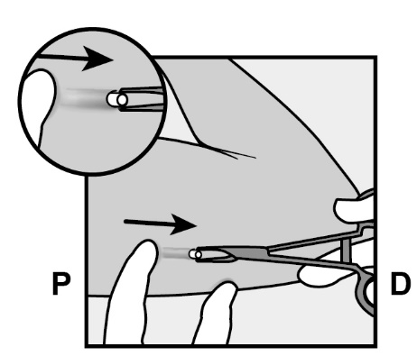 Pinza che afferra una capsula, frecce indicano la direzione e le lettere P e D identificano i poli della capsula