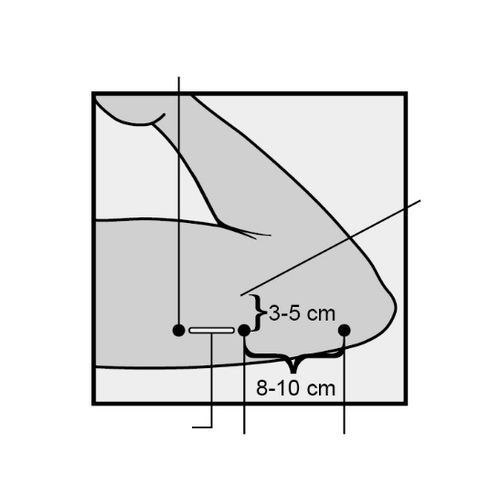 Schema di iniezione sottocutanea con indicazione della distanza di 3-5 cm e 8-10 cm dal punto di iniezione