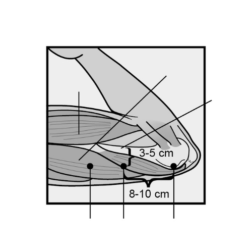 Sezione del ginocchio con indicazioni di misurazione da 3-5 cm e 8-10 cm con punti neri che indicano i siti di iniezione