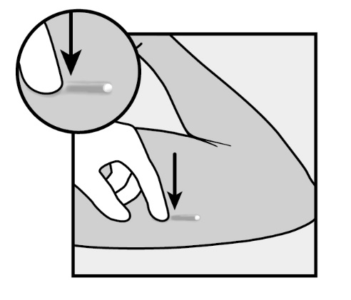 Mano che pizzica la pelle con due dita mostrando un piccolo rigonfiamento bianco e una freccia indica il punto di iniezione