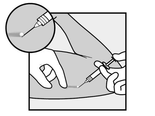 Mano che tiene una siringa con ago che inietta il farmaco nel tessuto sottocutaneo del braccio, con ingrandimento del punto di iniezione