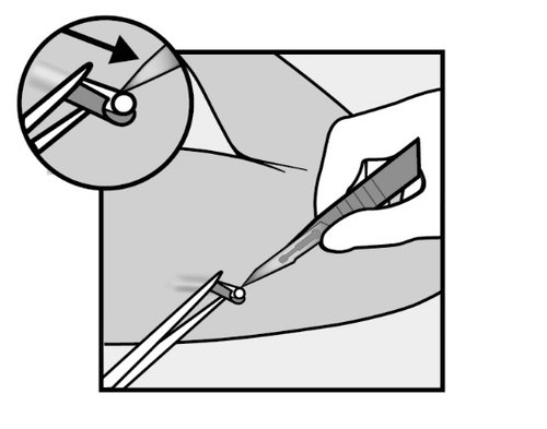 Mano che tiene una siringa con ago inserito nella pelle, freccia che indica la direzione di inserimento e dettaglio ingrandito del punto di iniezione