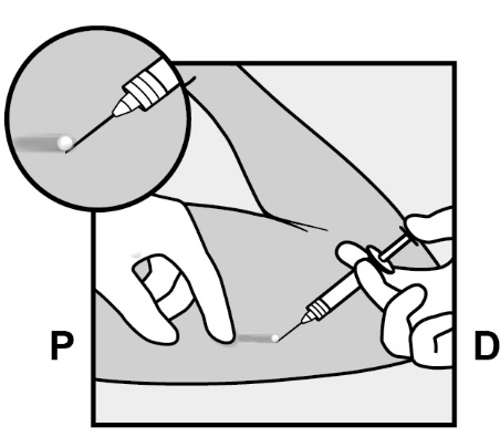 Mano che tiene una siringa inclinata per iniezione sottocutanea con ago inserito nella pelle indicata dalla lettera P e dettaglio ingrandito