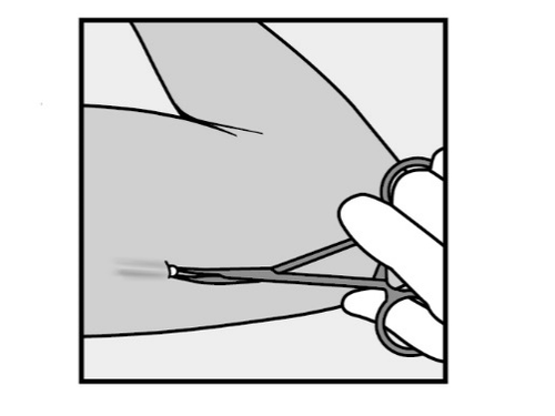 Pinzetta che afferra una piccola spina conficcata sotto la pelle chiara di una coscia umana