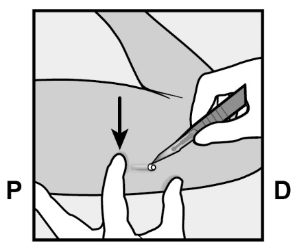 Mano guantata che inserisce un ago sottocutaneo con un