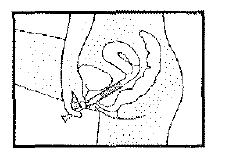 Disegno schematico di una mano che inserisce un dispositivo medico sottocutaneo nell