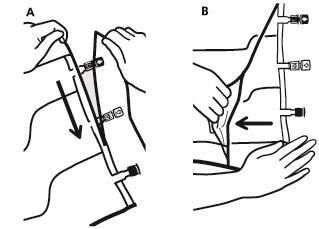Mano che collega un dispositivo medico a un catetere venoso centrale con freccia nera indicante la direzione