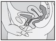 Disegno schematizzato del sistema riproduttivo femminile con inserimento di un applicatore intravaginale