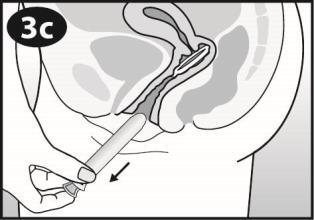 Applicatore intravaginale inserito con inclinazione corretta, freccia indica la direzione di inserimento nell