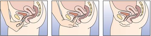 Tre fasi di inserimento di un applicatore vaginale con ovulo all
