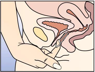Mano che inserisce un tampone igienico interno nell