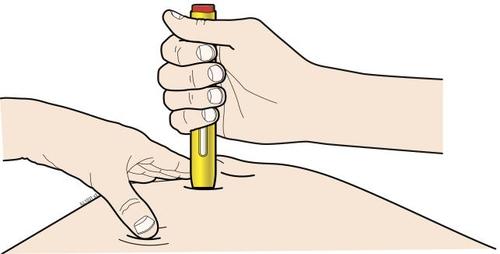 Mano che tiene un dispositivo autoiniettante giallo mentre inietta il farmaco nella pelle del braccio teso di un paziente