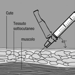 Siringa con ago inclinata a 45 gradi che penetra nel tessuto sottocutaneo e muscolo con indicazione delle strutture anatomiche