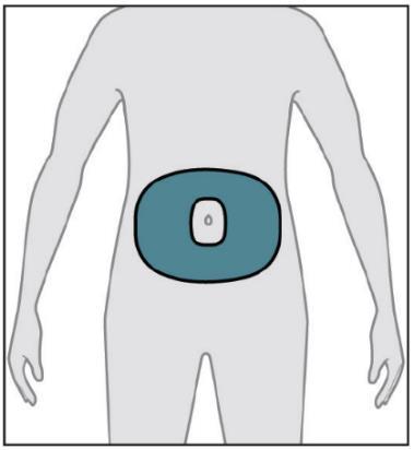 Figura schematica di schiena umana con area addominale evidenziata in blu scuro e dispositivo medico applicato