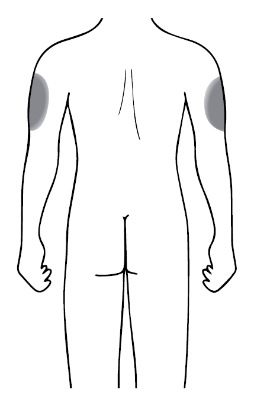 Schizzo di schiena umana con indicazione delle aree di iniezione deltoidee ombreggiate e linea mediana vertebrale visibile