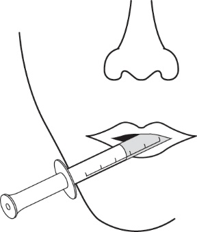 Siringa con ago inserito obliquamente nella cute, evidenziando strati sottocutanei e osso sottostante in sezione trasversale
