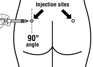 Schizzo di gluteo con frecce che indicano i siti di iniezione e siringa che inietta ad angolo di 90 gradi