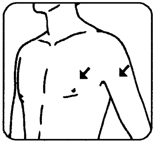 Schizzo del torso umano con frecce nere che indicano i punti di iniezione nell