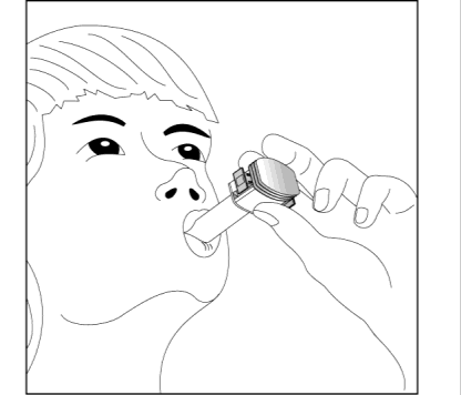 Mano che introduce un inalatore orale nella bocca aperta di un paziente con le labbra socchiuse