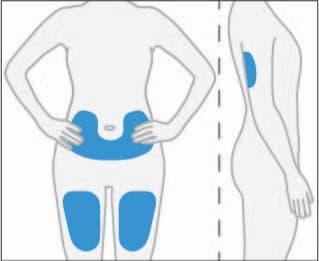 Corpo umano stilizzato con aree evidenziate in blu che indicano possibili siti di iniezione sottocutanea addominale e glutea