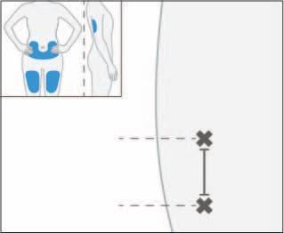 Schizzi di figure umane con aree blu che indicano siti di iniezione nella parte superiore del braccio e nella parte bassa della schiena