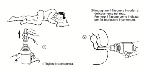 Paziente sdaiato lateralmente con freccia che indica sito di iniezione e flacone collegato a siringa per somministrazione rettale