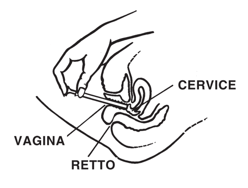 Mano che inserisce un ago nella regione cervicale, con indicazioni di vagina e retto vicino alla zona di iniezione
