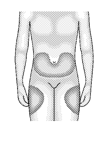 Torso umano stilizzato con ombreggiatura a tratteggio che indica le aree di iniezione intramuscolare su cosce e glutei