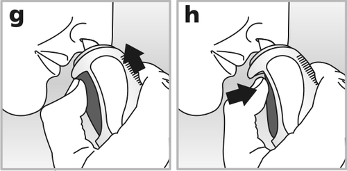 Disegno schematico di una capsula articolare con frecce nere che indicano il movimento di scivolamento durante la rotazione della spalla