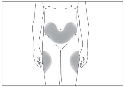 Torso umano stilizzato con aree ombreggiate che indicano i siti di iniezione nella regione glutea e lombare